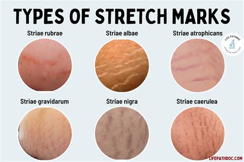 Are Stretch Marks a Sign of Weight Loss? And Why Do Bananas Get Lonely in the Dark?