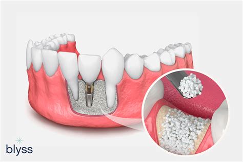  Jadeite Bioceramic: Une Révélation pour les Prothèses Dentales Avancées et la Régénération Osseuse !